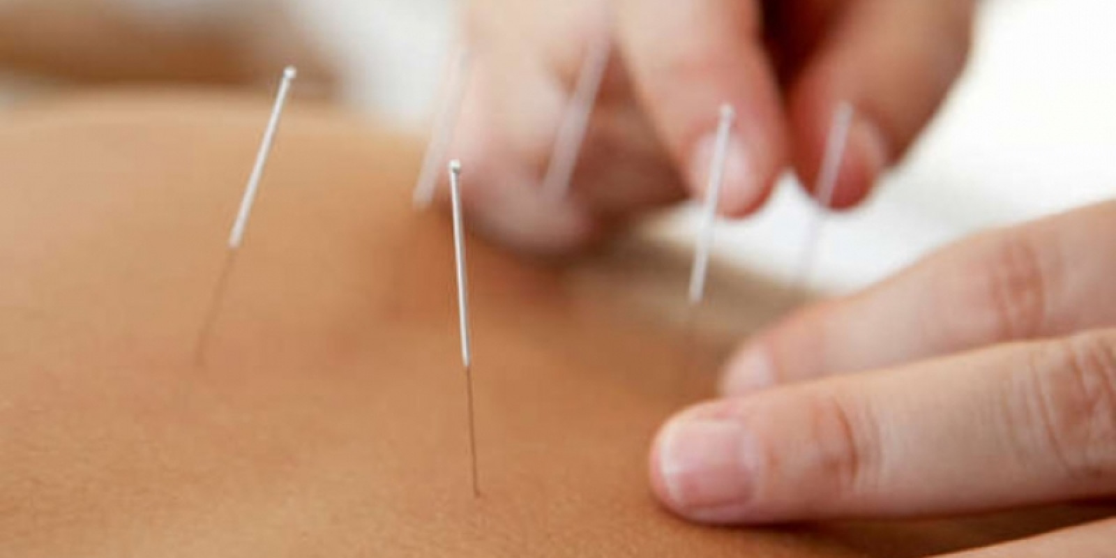 Planos e Promoções de tratamento com acupuntura e acupuntura estética facial e corporal