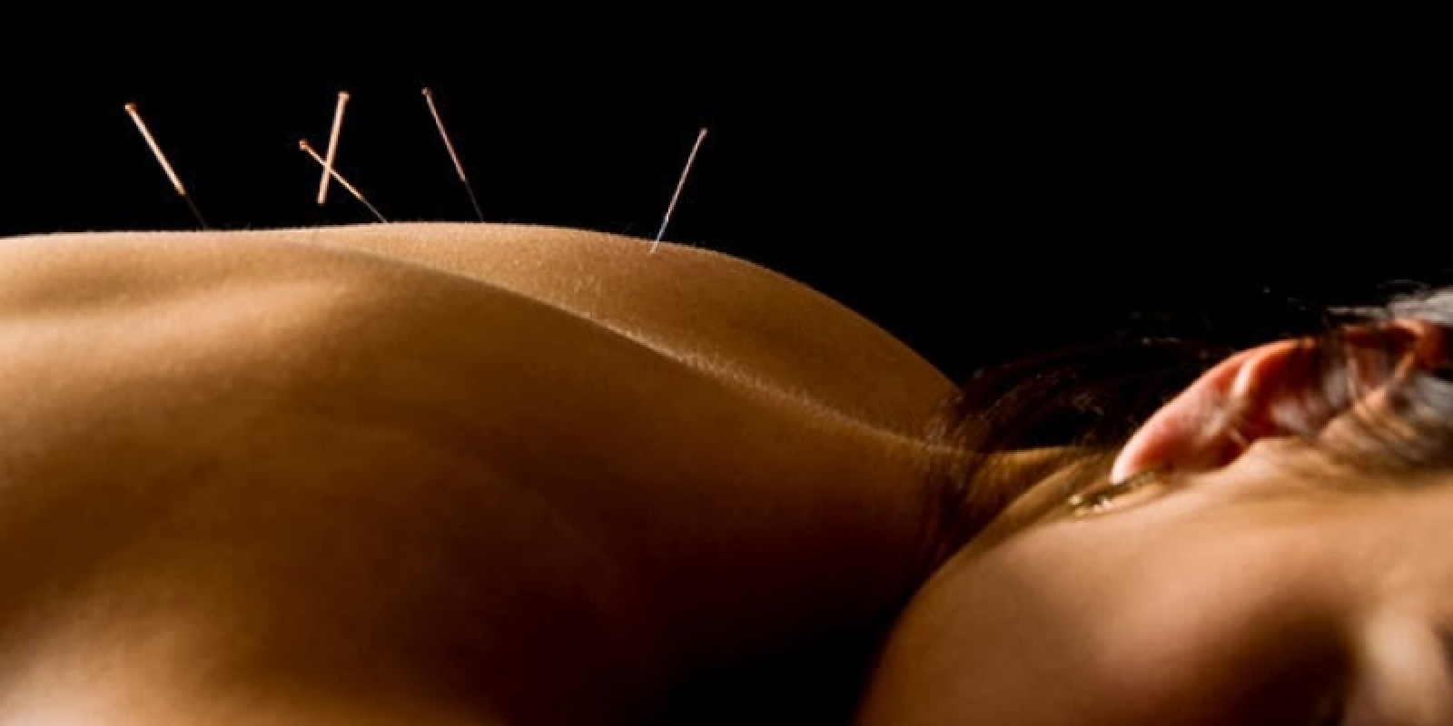 Estudo comprova benefícios da acupuntura após cirurgia de câncer de mama