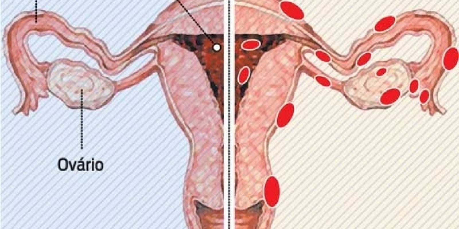 Medicina Tradicional Chinesa auxilia no tratamento da Endometriose