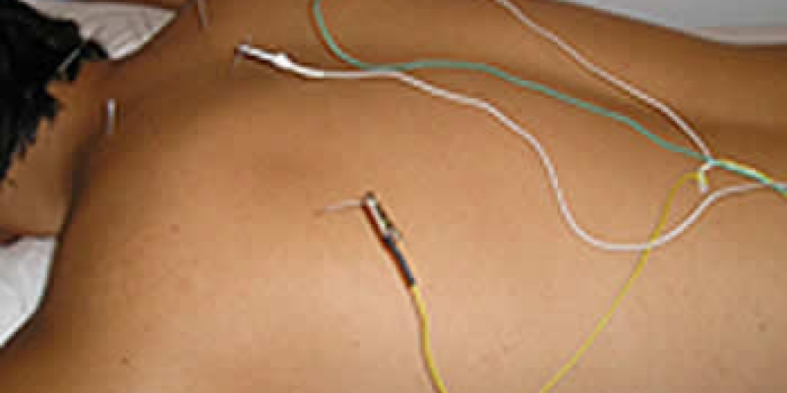 Os efeitos da eletro acupuntura no alí­vio da dor nas costas