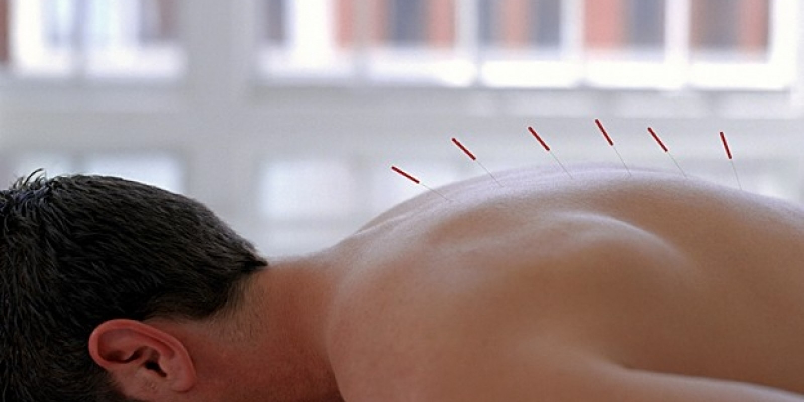 Confira alguns dúvidas sobre acupuntura