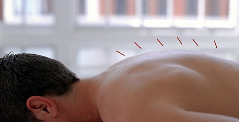 Confira alguns dúvidas sobre acupuntura